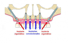 La Clínica Curull, el primer centro de Tarragona en realizar implantes zigomáticos mediante el método ZAGA