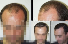 Injerto capilar en España con Medical Graft