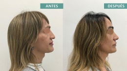 La frente es un rasgo facial determinante en la reafirmación de género, según una revisión de estudios 