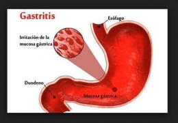 Di adiós a la Gastritis