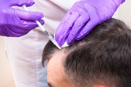 Descubre la clínica para la alopecia en Granada más recomendable