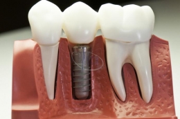 Cuidados necesarios para implantes dentales
