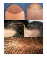 Microinjertos capilares, dos siglos de lucha contra la alopecia