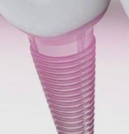 Tipo de implantes dentales en 2018 - ¿Y para qué sirve cada uno de ellos?
