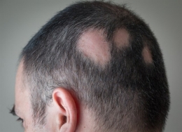 Cómo encontré, por fin, la solución para la alopecia en Granada 