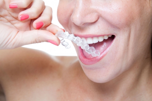 Ventajas de Invisalign frente a la ortodoncia tradicional