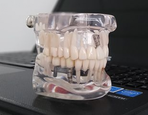 El desgaste y pérdida de los dientes