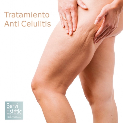 Maneras de combatir la celulitis este verano de manera efectiva y segura en Servi Estétic