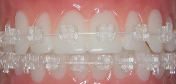 Conoce los brackets transparentes de zafiro