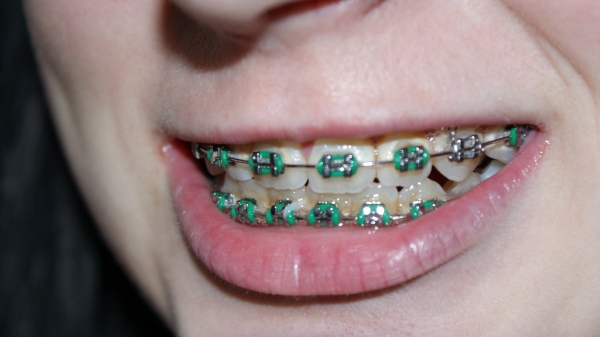 Brackets de Colores